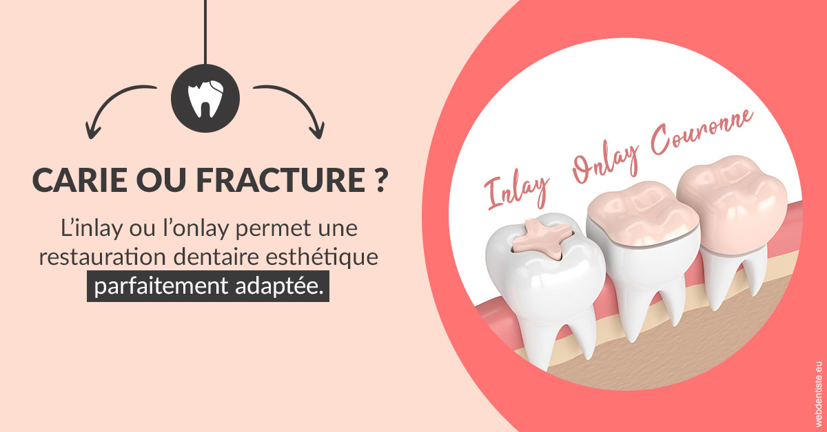 https://dr-philippe-borel.chirurgiens-dentistes.fr/T2 2023 - Carie ou fracture 2