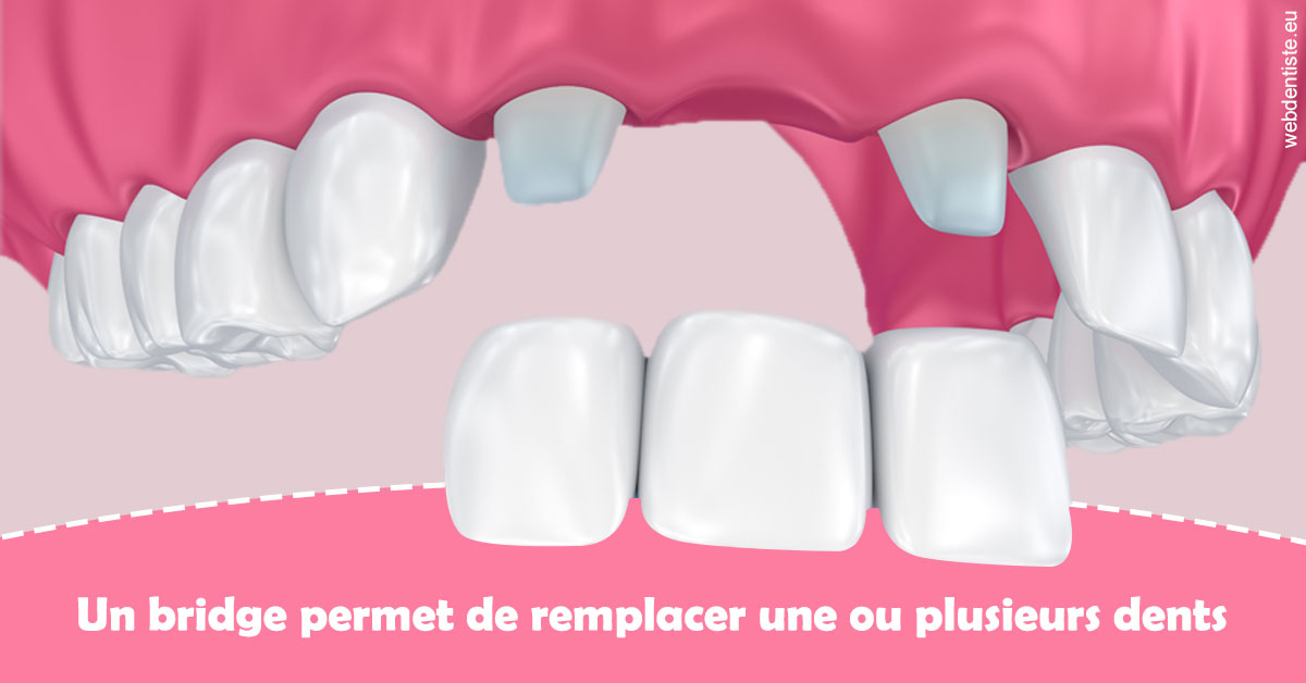 https://dr-philippe-borel.chirurgiens-dentistes.fr/Bridge remplacer dents 2