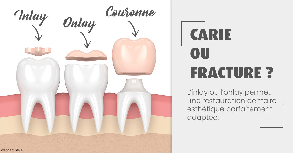 https://dr-philippe-borel.chirurgiens-dentistes.fr/T2 2023 - Carie ou fracture 1